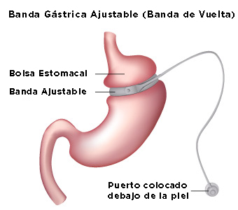Banda G&aacute;strica Ajustable (Banda de Vuelta)