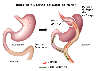 Roux-en-Y Derivaci&oacute;n G&aacute;strico (RNY)