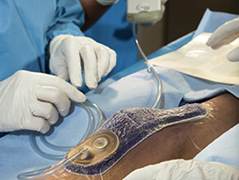 UI Health Lidera un Estudio Sobre el Tratamiento de Heridas Con Terapia de Presión Negativa en Pacientes Obesos y Diabéticos