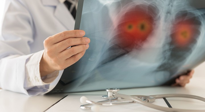 Lung Cancer Isn’t Just a Smoker’s Disease